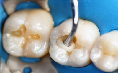 Этапы лечения зубов - Медикус